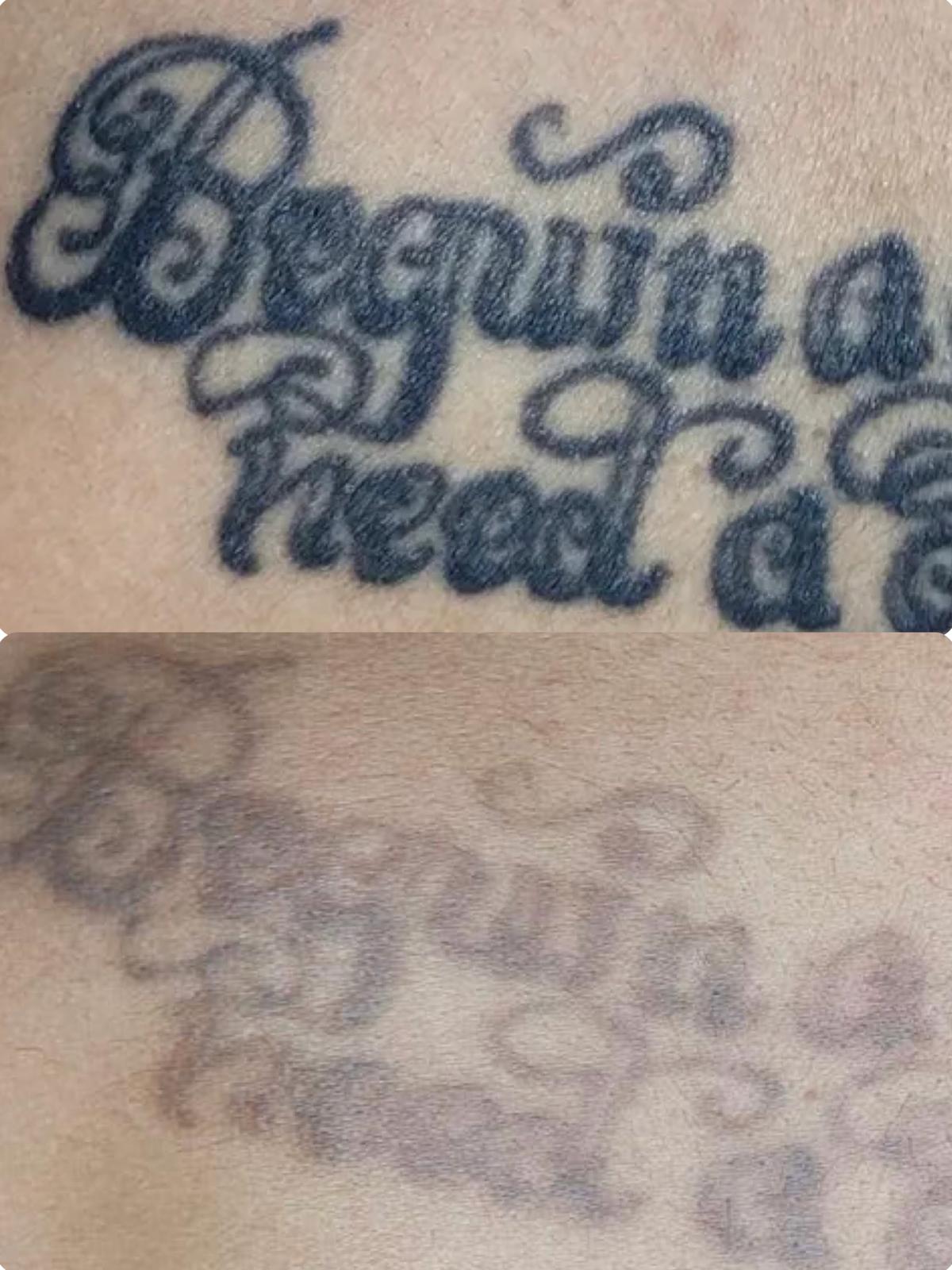 Eliminación de tatuaje con láser antes y después — Isabel Santamaría Sabadell